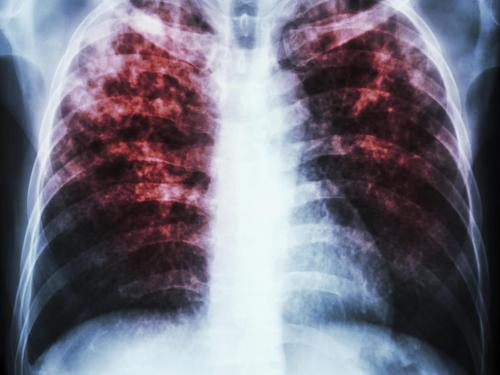 Scan radiologique d'un cancer du poumon avancé causé par une exposition au radon